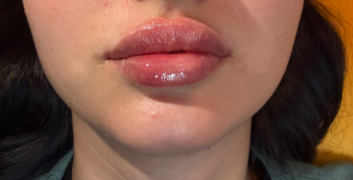 Lip Enhancement after