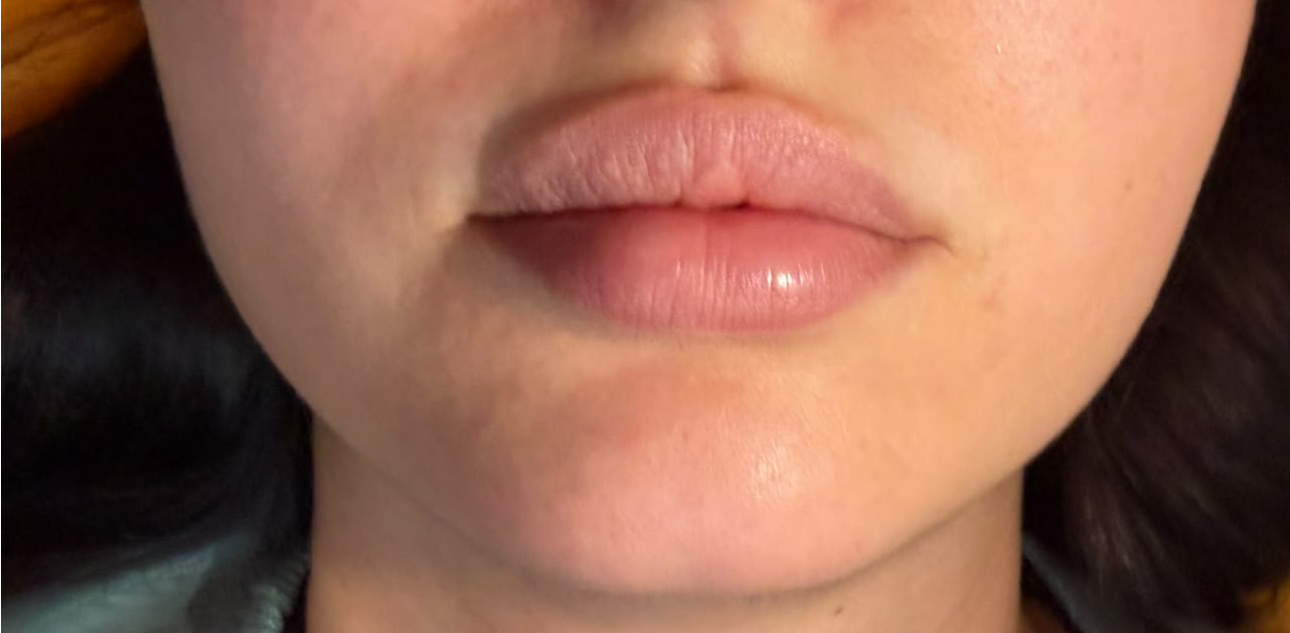 Lip Enhancement before