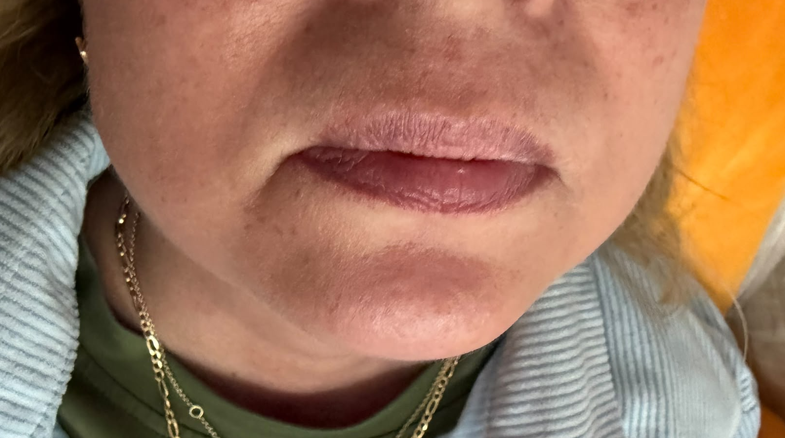 Lip Enhancement before