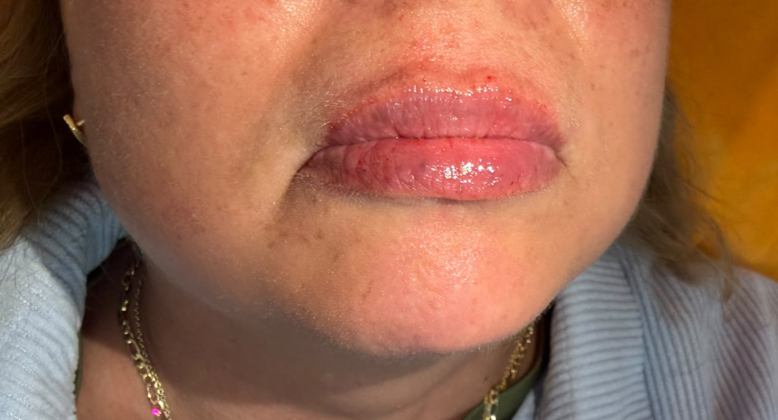 Lip Enhancement after