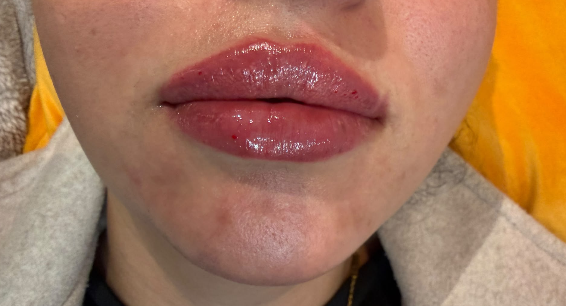 Lip Enhancement after