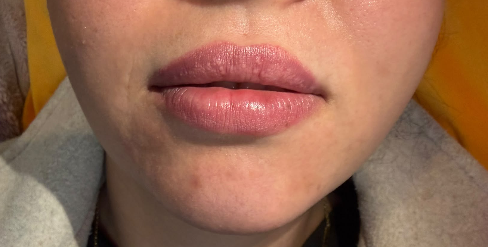 Lip Enhancement before