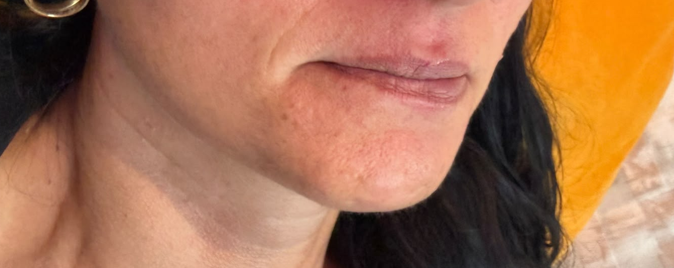 Lip Enhancement before