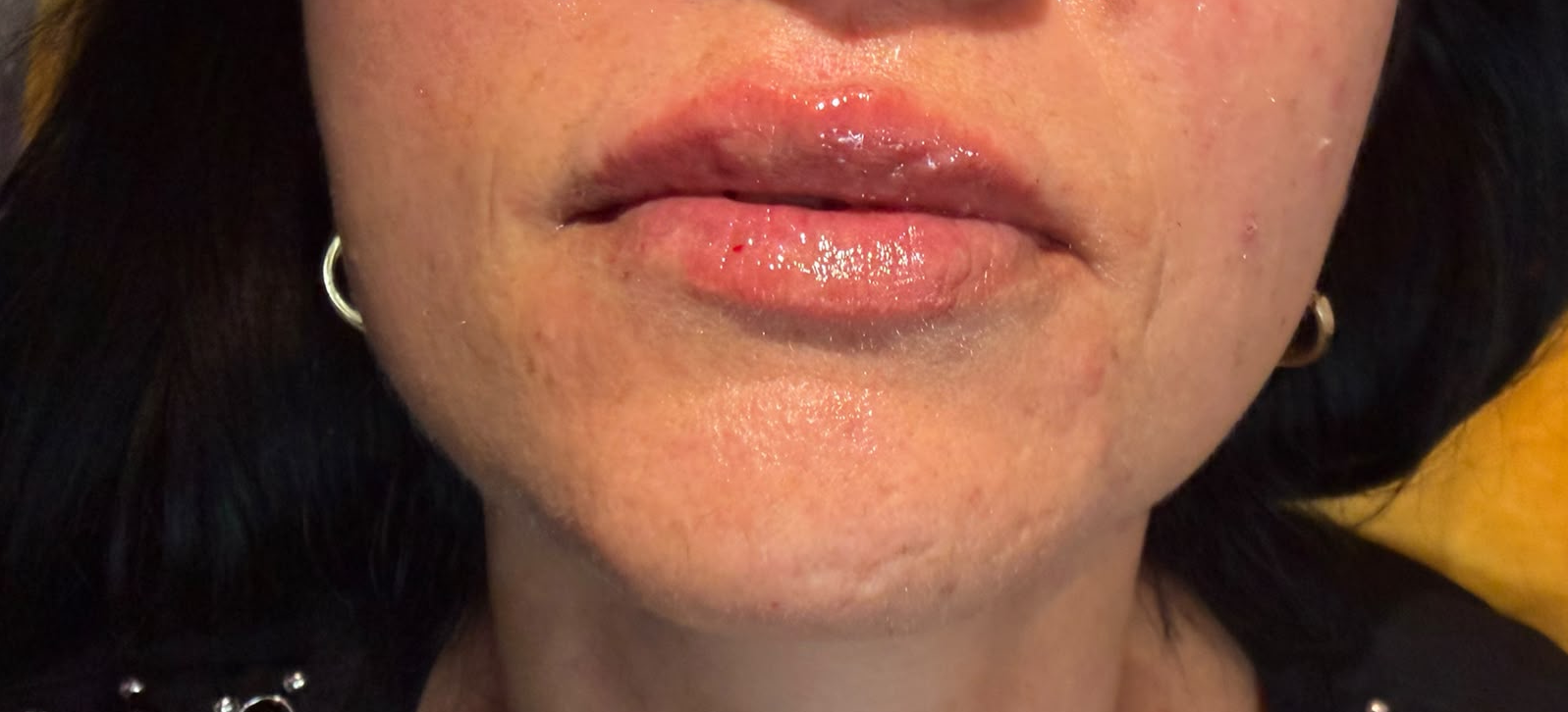 Lip Enhancement after