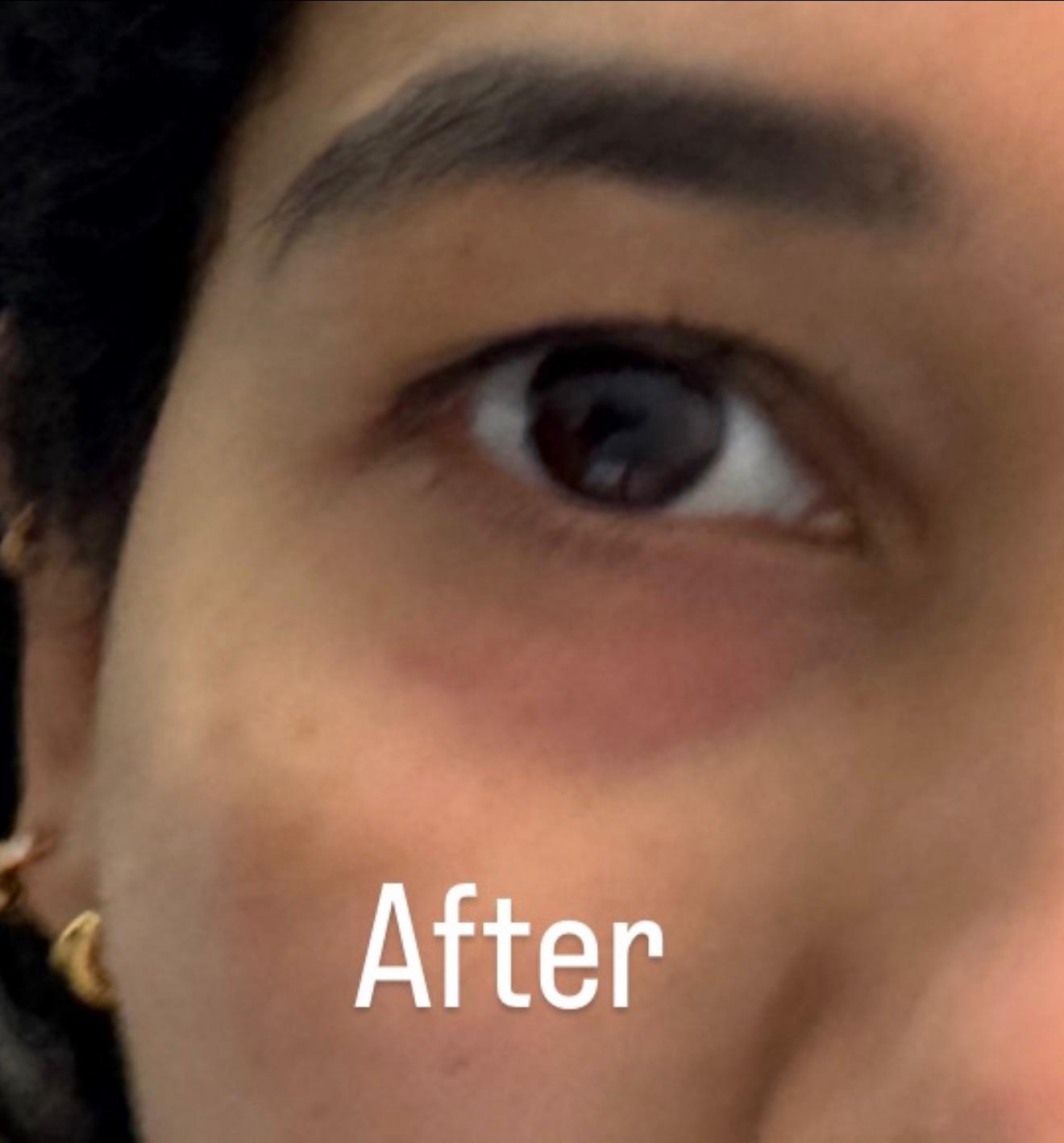 Face Treatment - Before & After after
