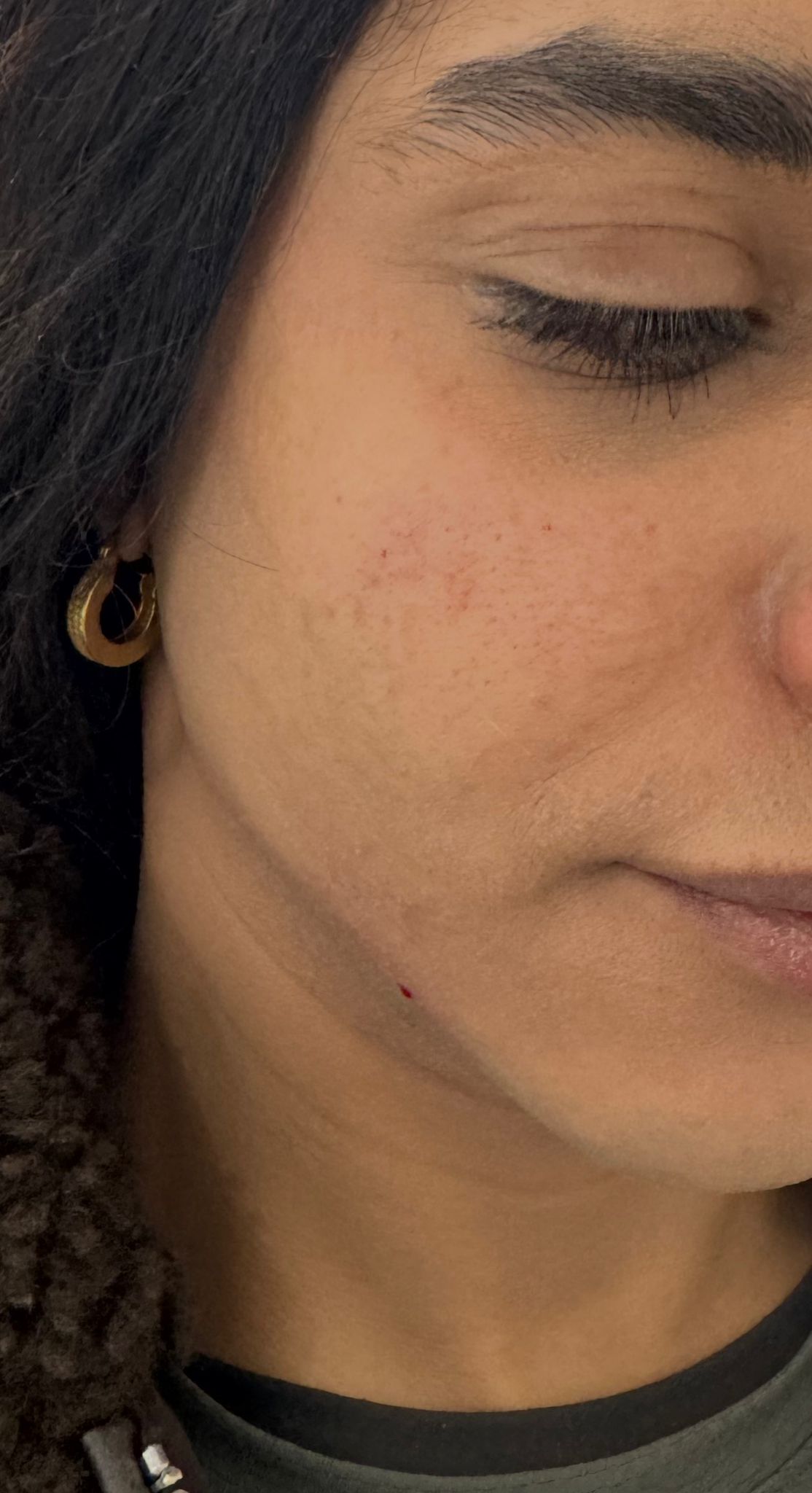Jaw Line Enhancement after