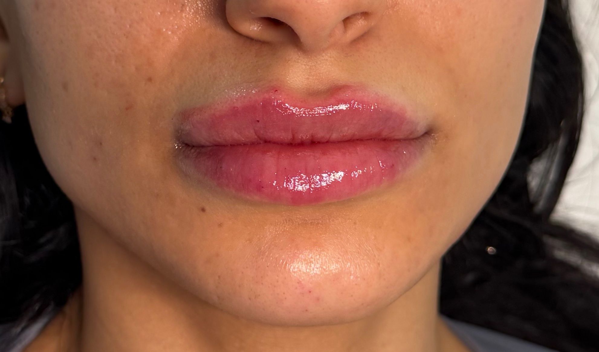 Lip Enhancement after