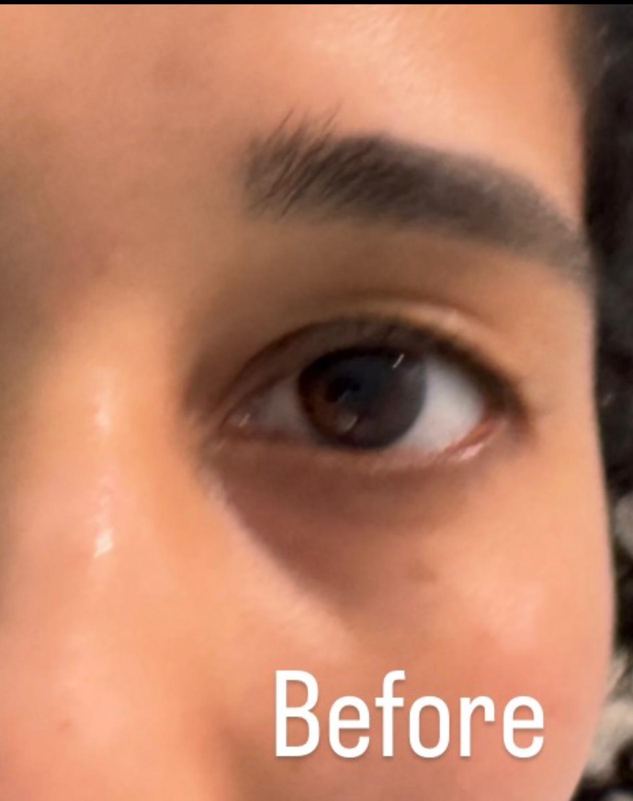 Face Treatment · Before & After before