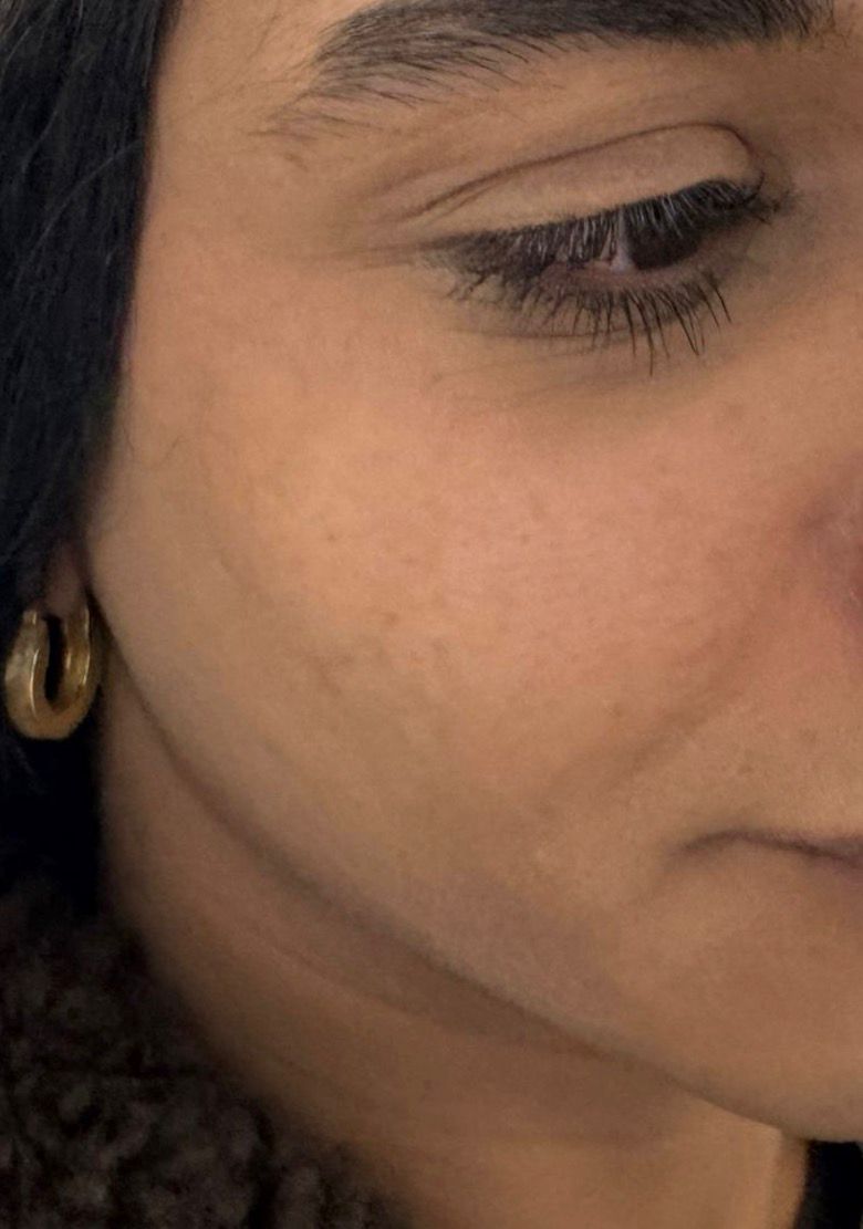 Jaw Line Enhancement before