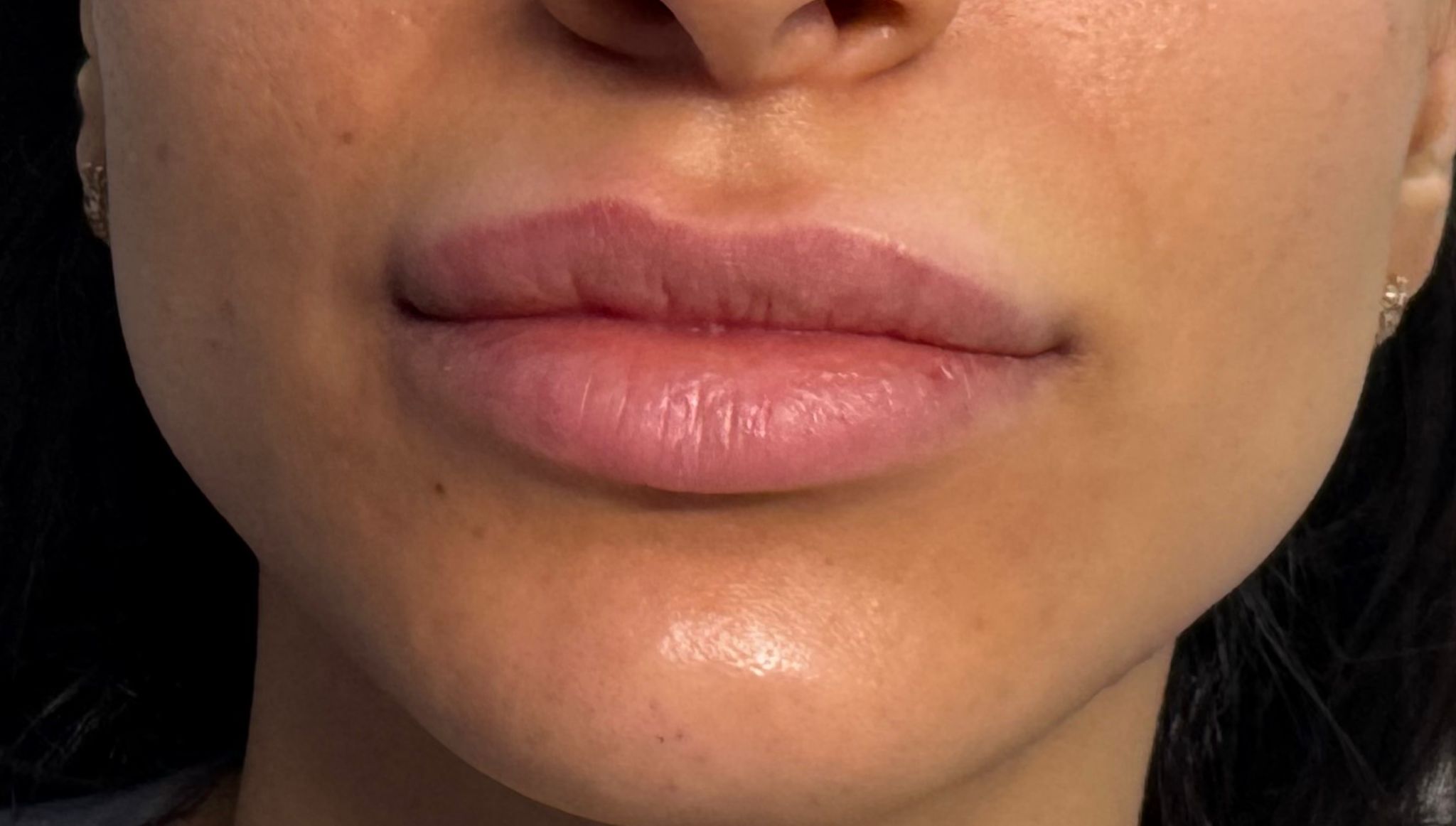 Lip Enhancement before