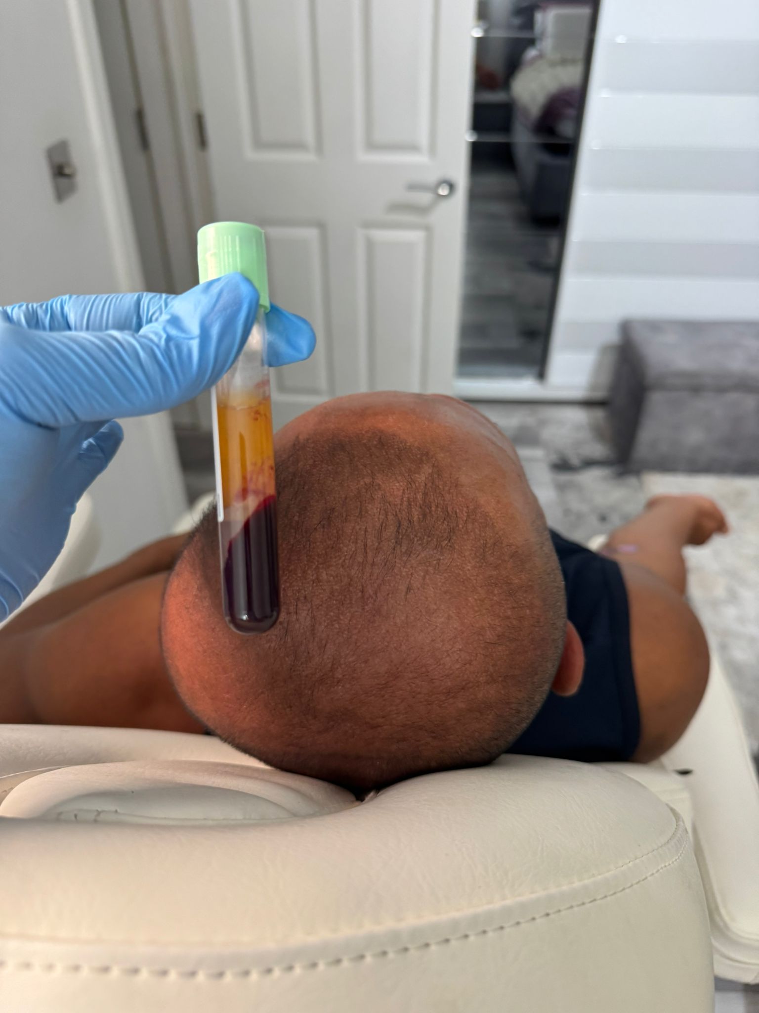 PRP Hair Treatment