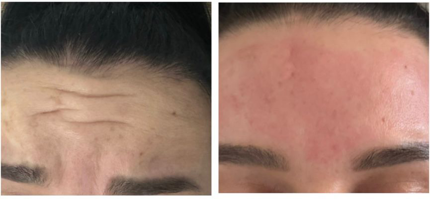 Anti-Wrinkle · Botox