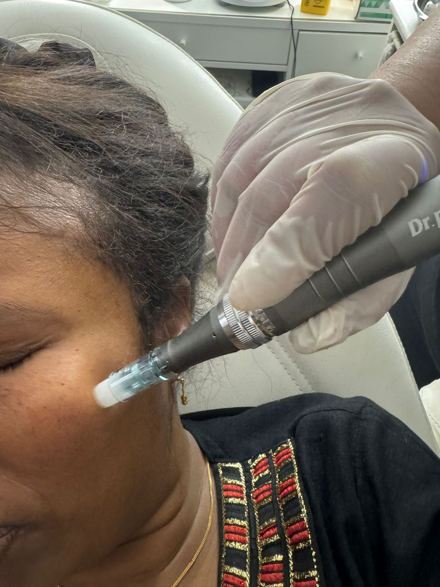 Skin Boost · Microneedling