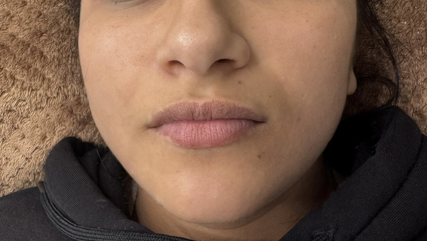 Lip Enhancement before