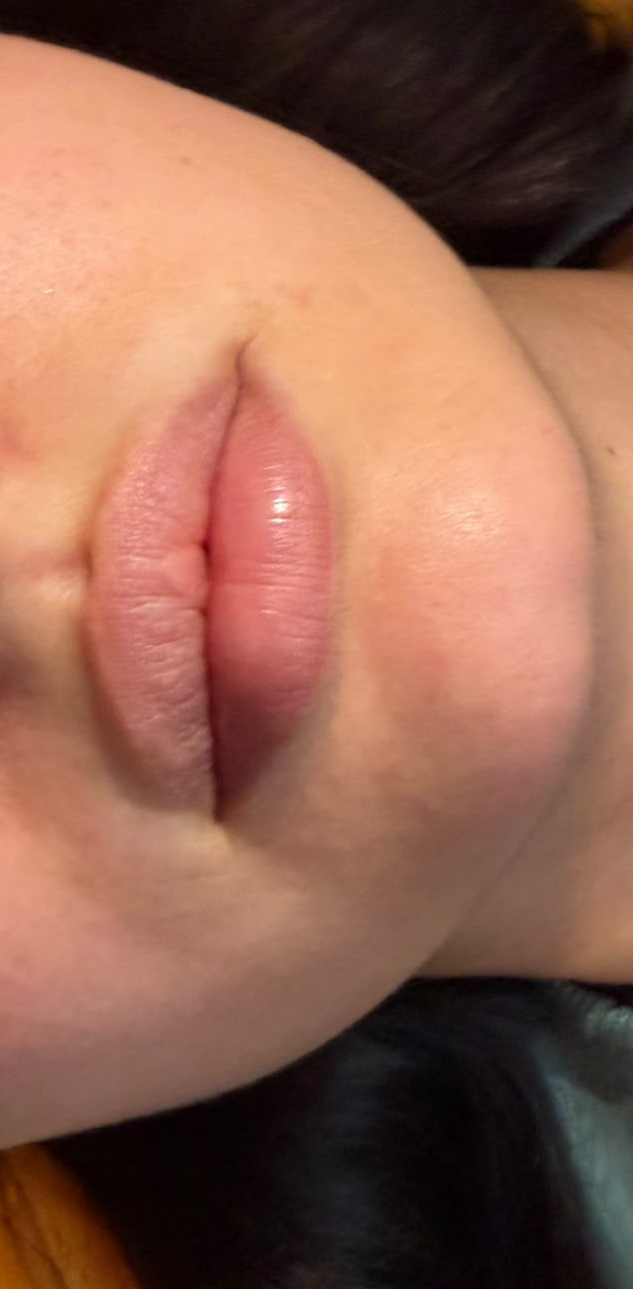 Lip Enhancement before