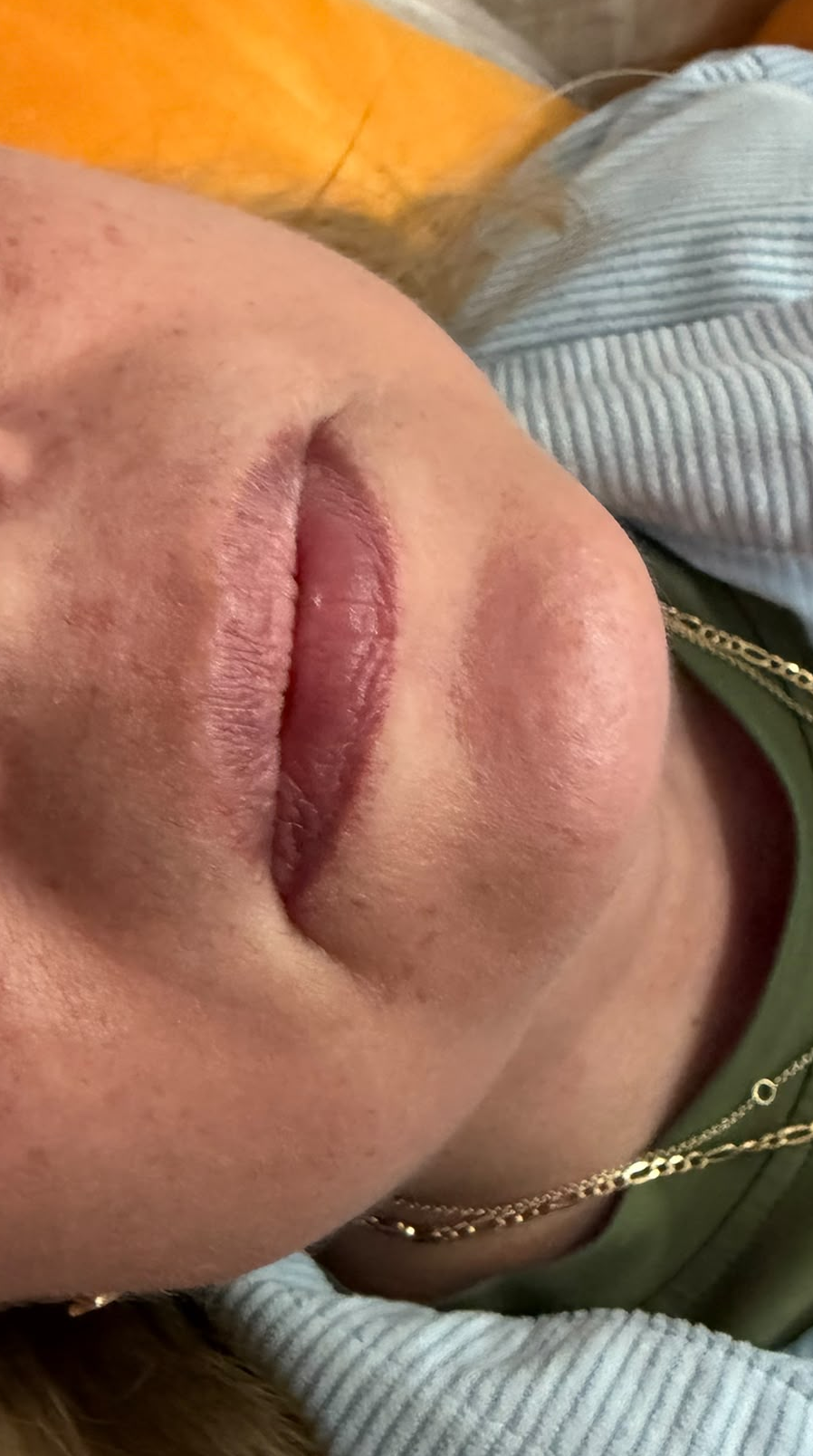 Lip Enhancement before