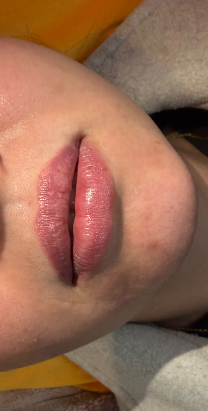 Lip Enhancement before
