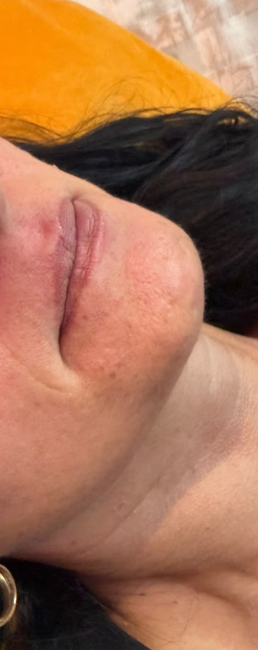 Lip Enhancement before