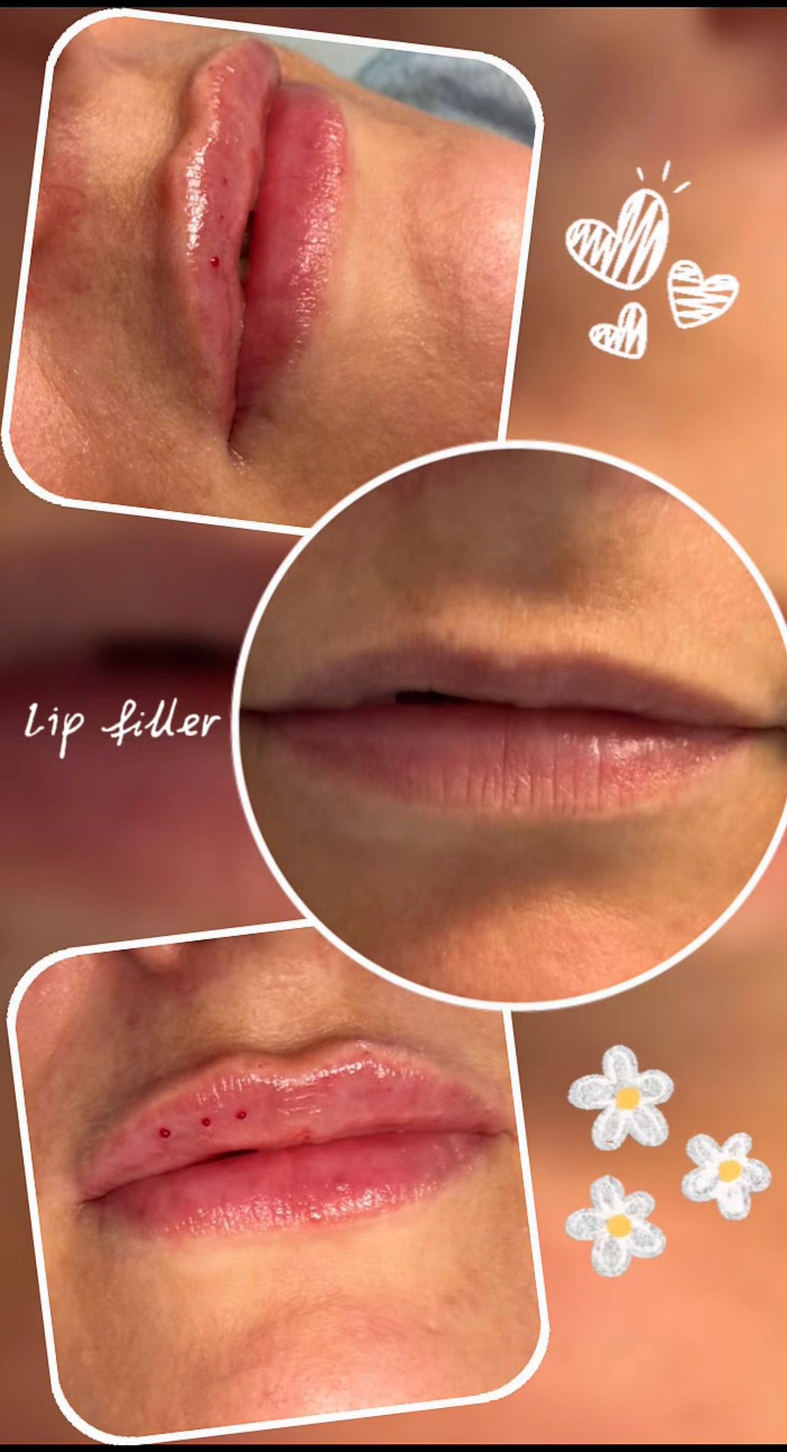Lip Enhancement