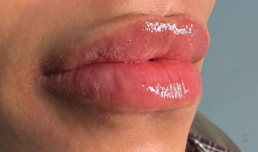 Lip Enhancement