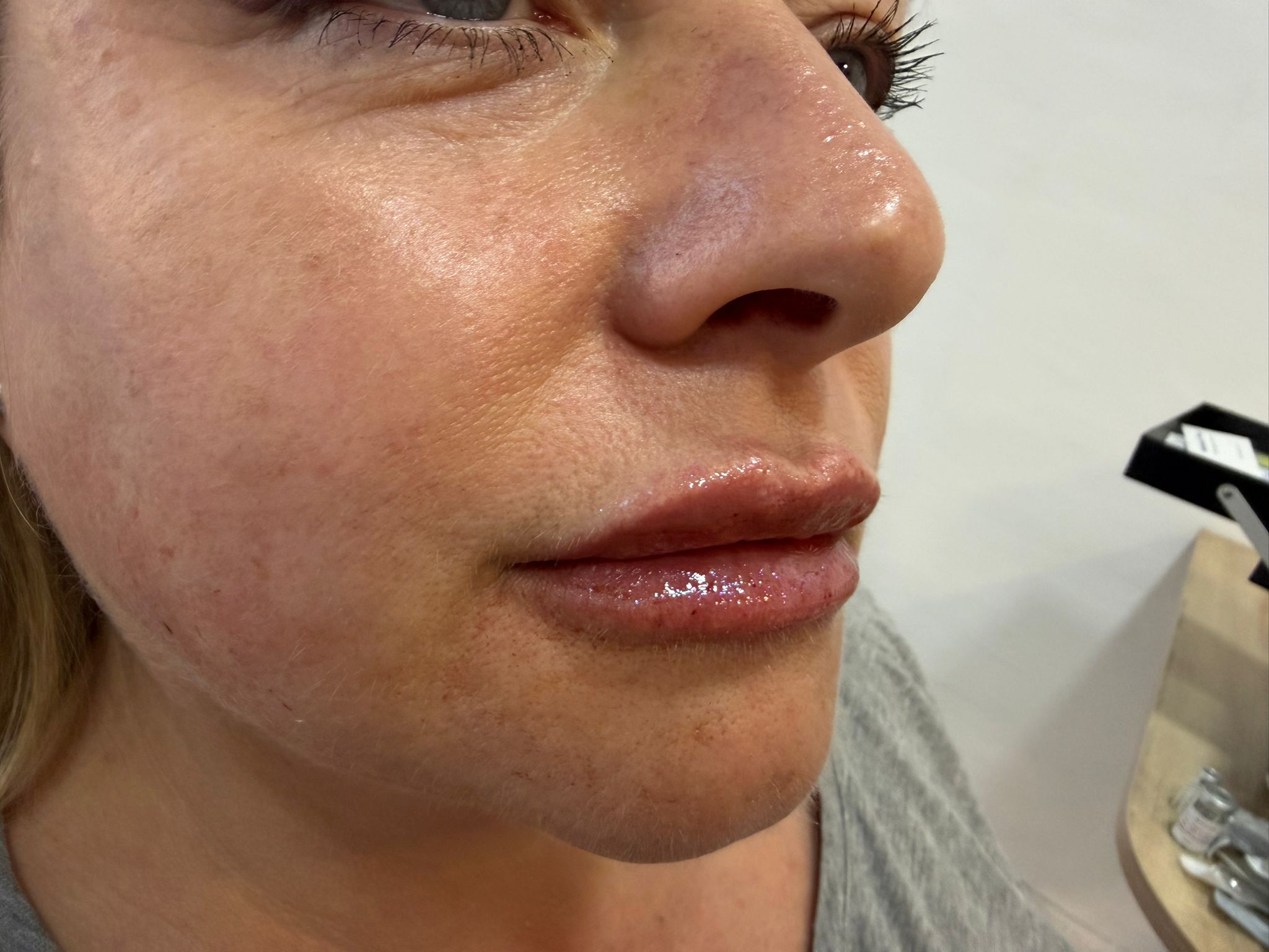 Lip Enhancement