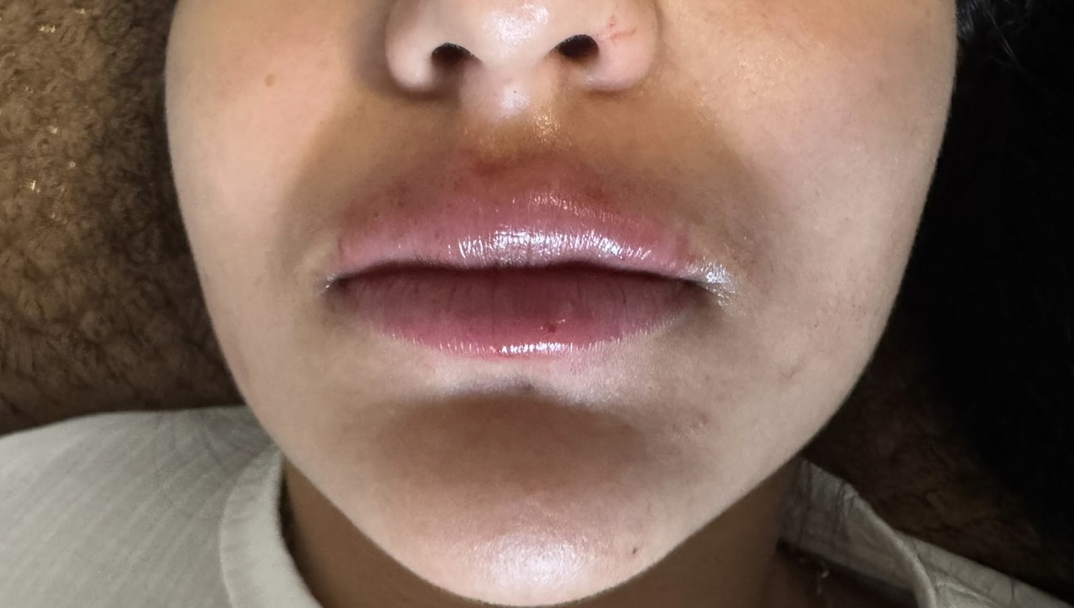Lip Enhancement before
