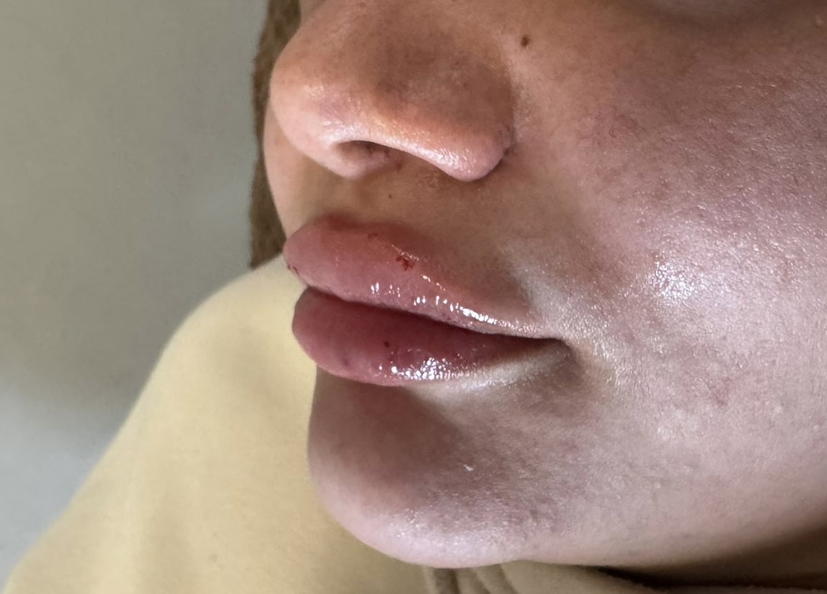 Lip Enhancement before