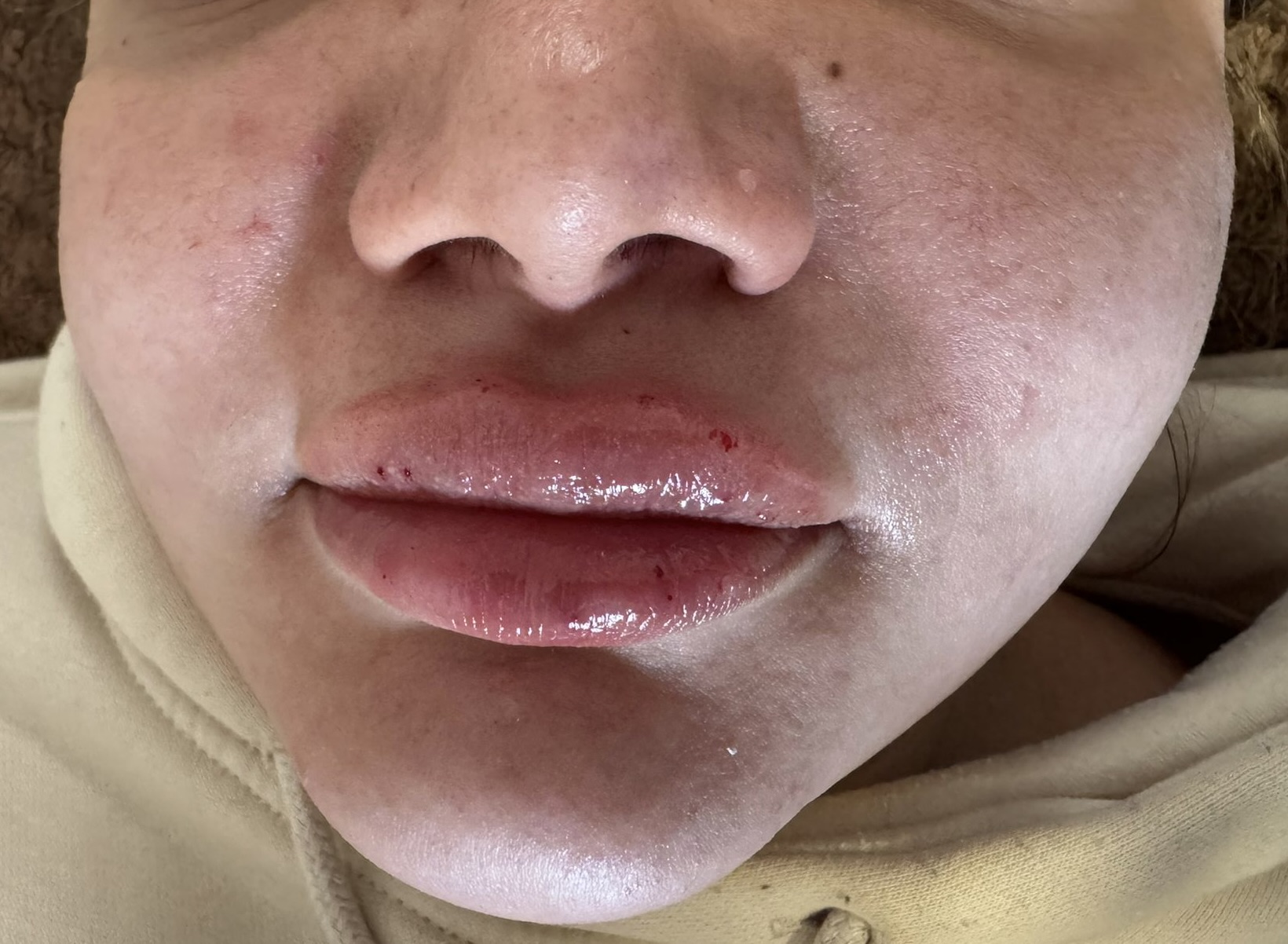 Lip enhancement result