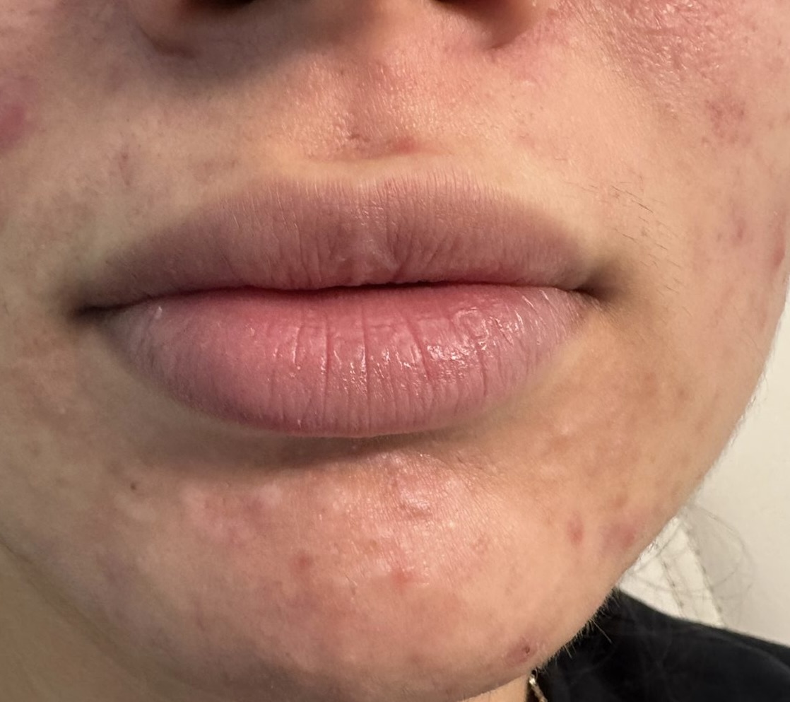 Lip Enhancement before