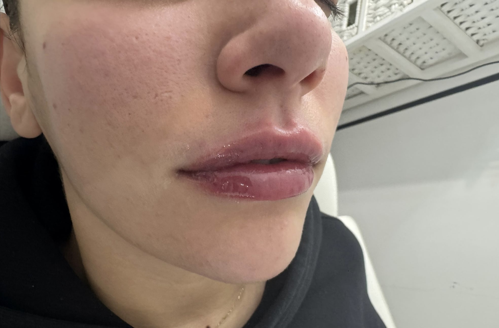 Lip Enhancement after