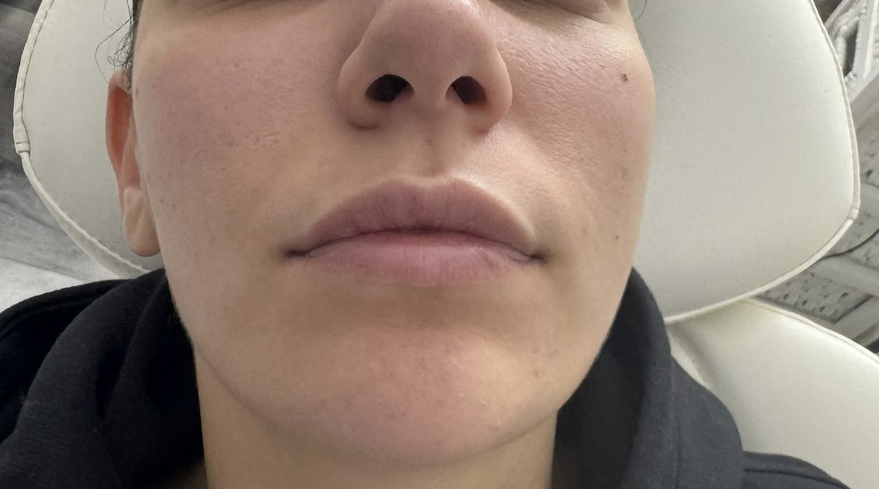Lip Enhancement before