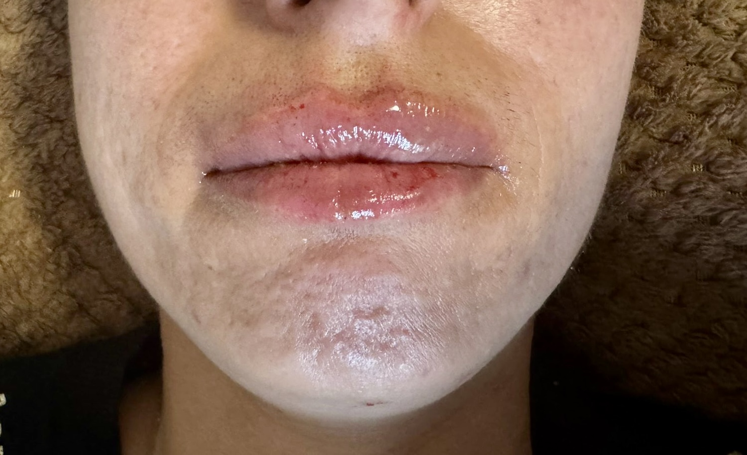 Lip Enhancement before