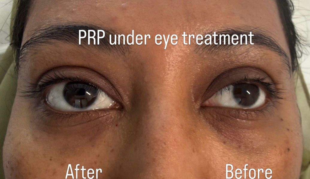 Under Eye Treatment