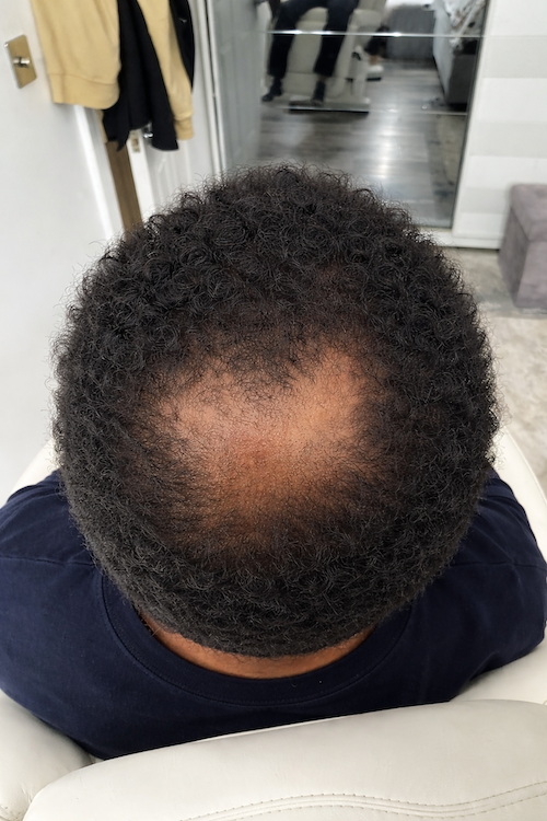 PRP hair treatment in Enfield