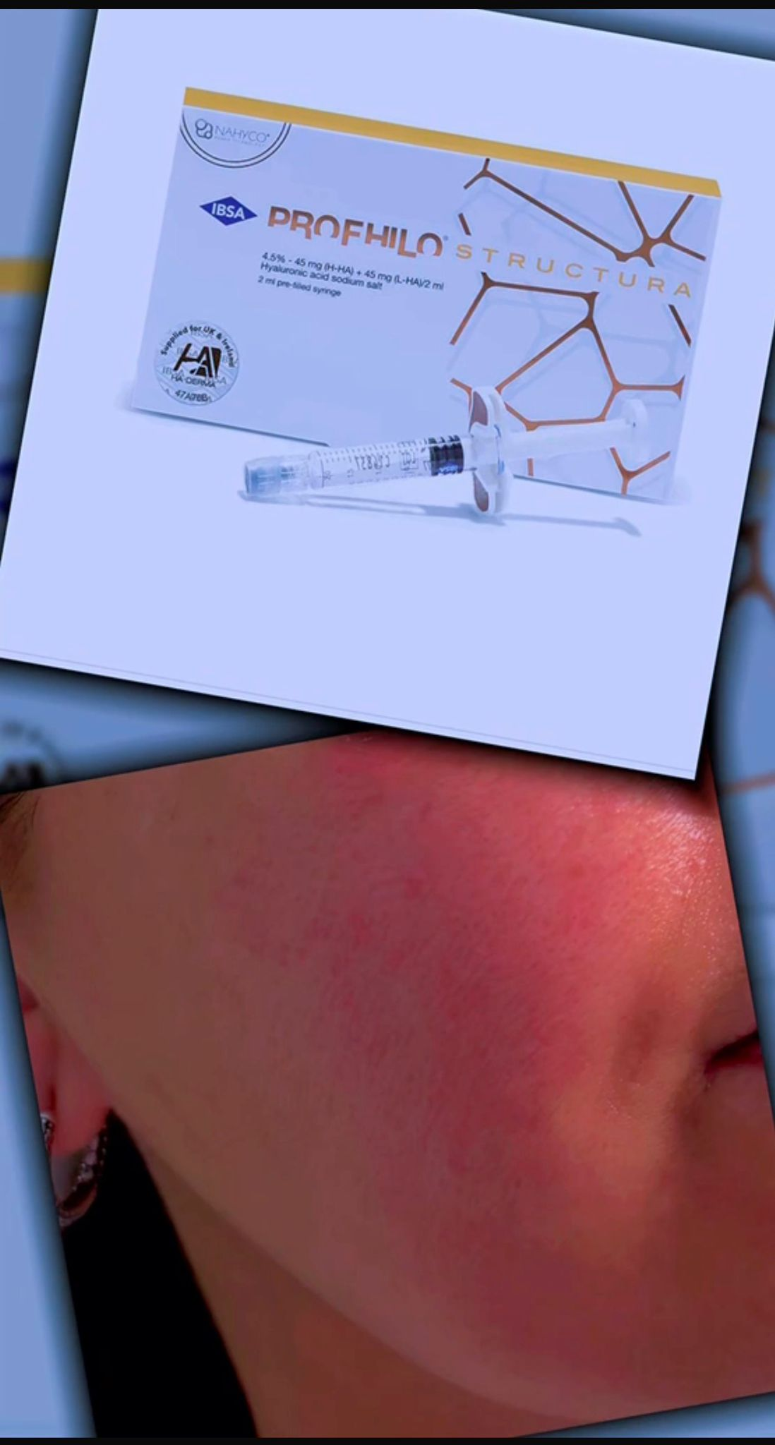 Profhilo Treatment
